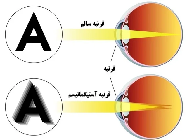 عیوب انکساری(Refractive errore) -نزدیک بینی(myopia) عيوب انکساري چشم