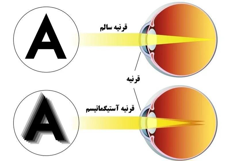 عیوب انکساری(Refractive errore) -نزدیک بینی(myopia) عيوب انکساري چشم